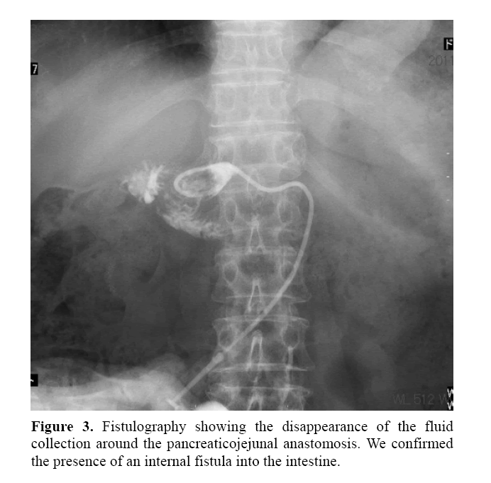 pancreas-fistulography-showing