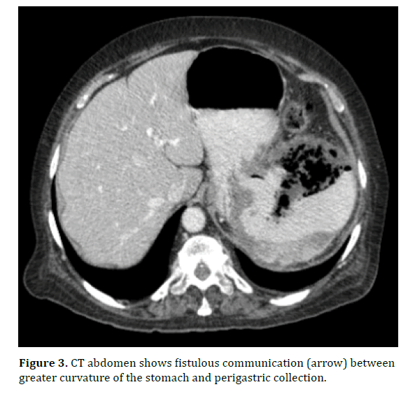 pancreas-fistulous