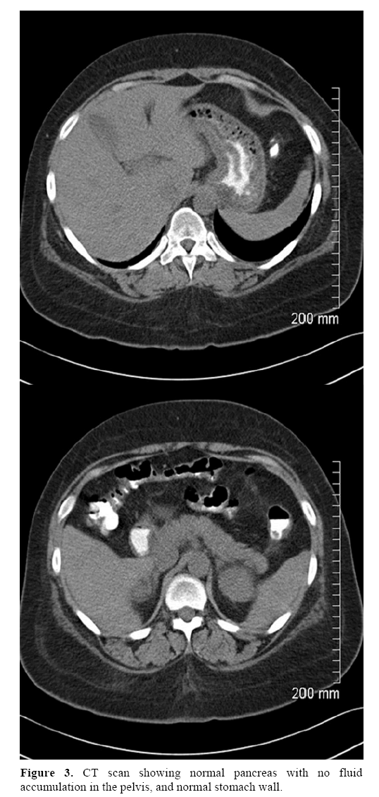 pancreas-fluid-accumulation