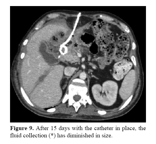 pancreas-fluid-collection-diminished