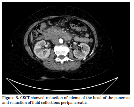 pancreas-fluid-collections-peripancreatic