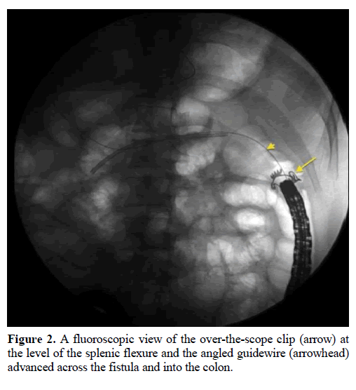 pancreas-fluoroscopic-over-the-scope