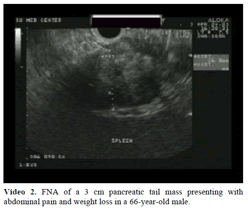 pancreas-fna-pancreatic-tail-mass