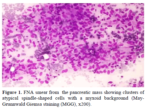 pancreas-fna-smear-pancreatic-mass