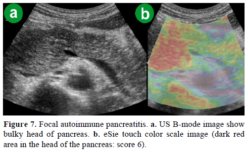 pancreas-focal-autoimmune-pancreatitis