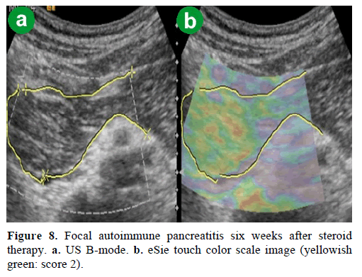 pancreas-focal-autoimmune-pancreatitis-steroid