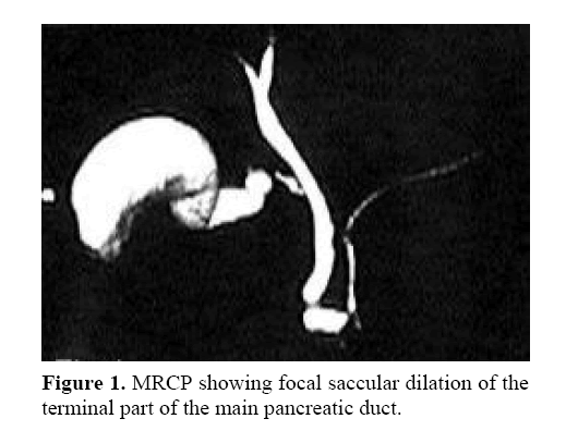 pancreas-focal-saccular-dilation
