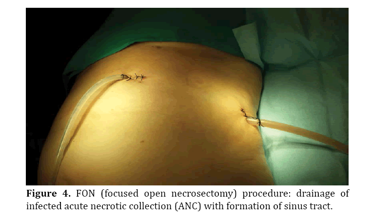 pancreas-focused-open-necrosectomy