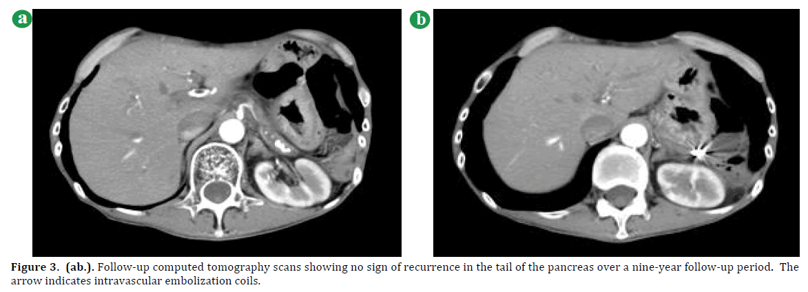 pancreas-follow-computed-tomography-scans