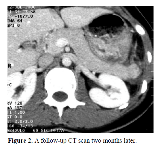pancreas-follow-up-CT-scan