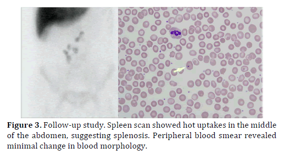 pancreas-follow-up-study-spleen