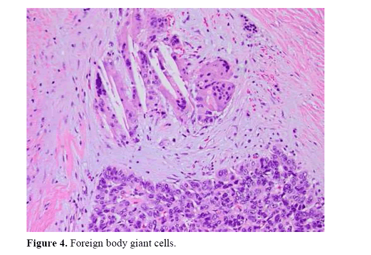 pancreas-foreign-body-giant-cells