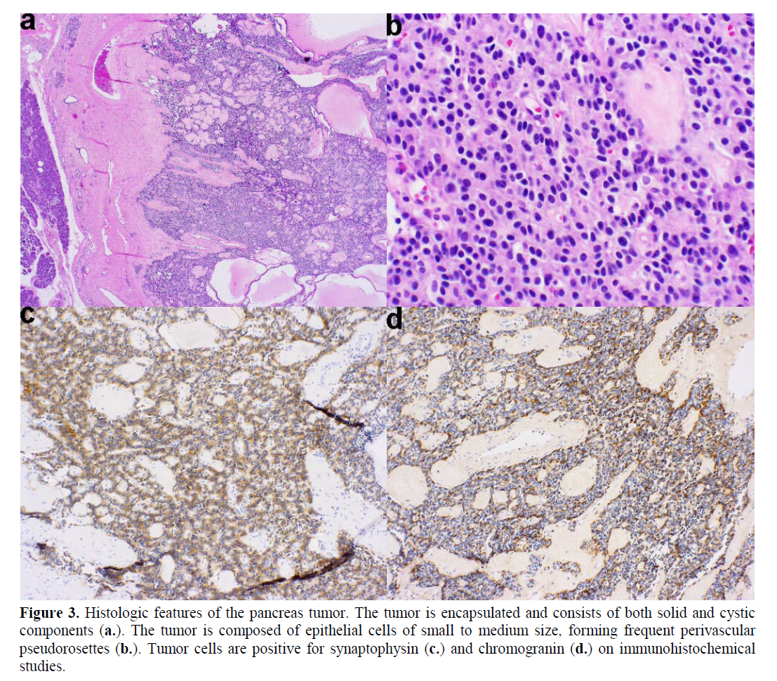 pancreas-forming-frequent-perivascular