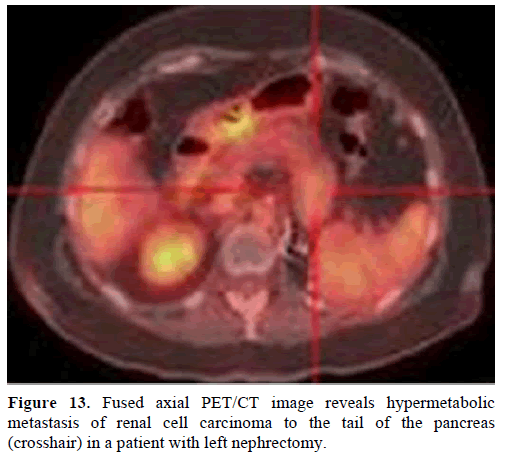 pancreas-fused-axial-cell-carcinoma