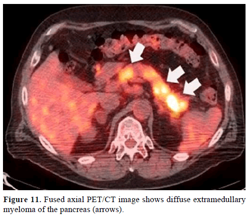 pancreas-fused-axial-extramedullary