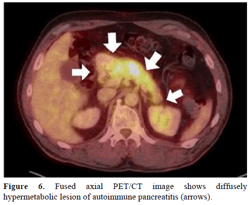 pancreas-fused-axial-hypermetabolic