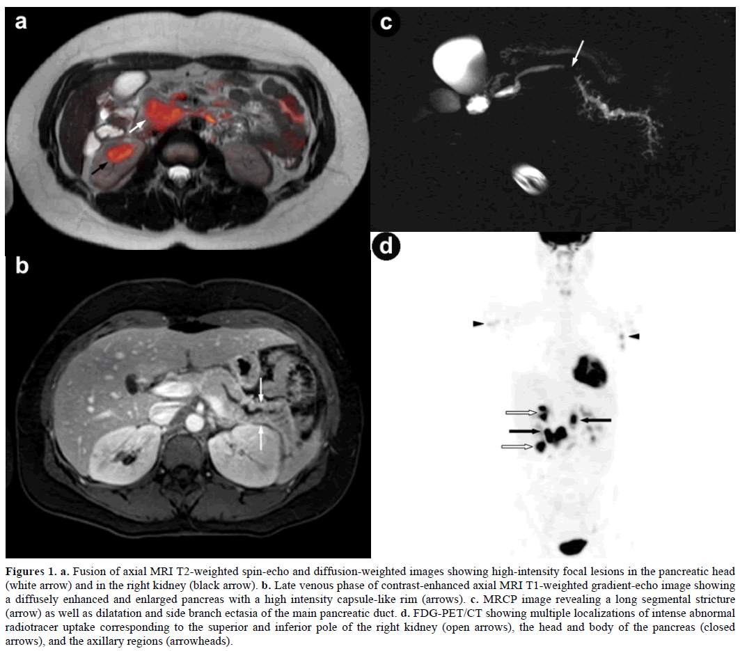 pancreas-fusion-weighted-spin-echo