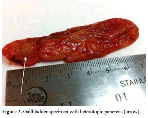pancreas-gallbladder-specimen-heterotopic