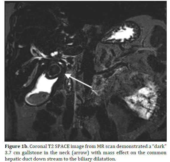 pancreas-gallstone