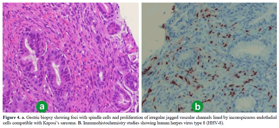 pancreas-gastric-biopsy-foci-spindle