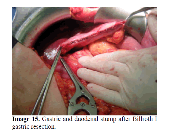 pancreas-gastric-duodenal-stump