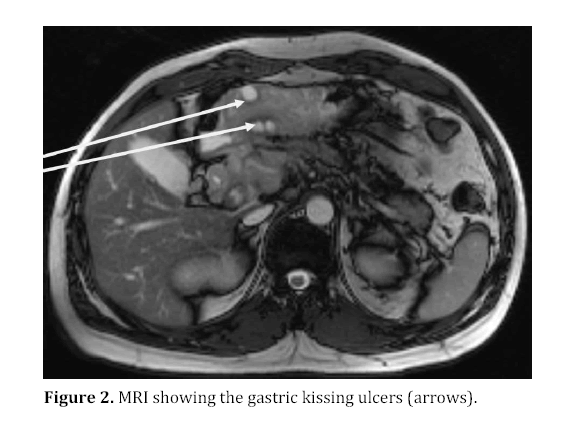 pancreas-gastric-kissing-ulcers