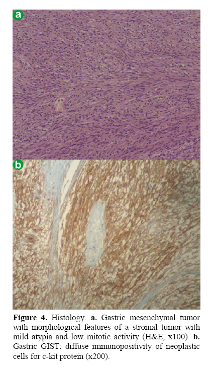 pancreas-gastric-mesenchymal-tumor