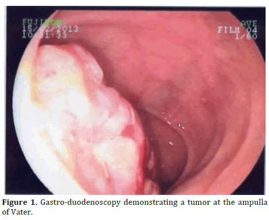 pancreas-gastro-duodenoscopy-tumor