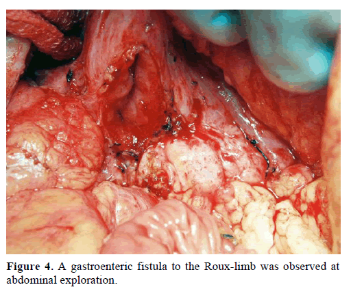 pancreas-gastroenteric-fistula-roux-limb