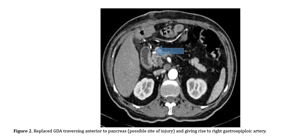 pancreas-gastroepiploic-artery