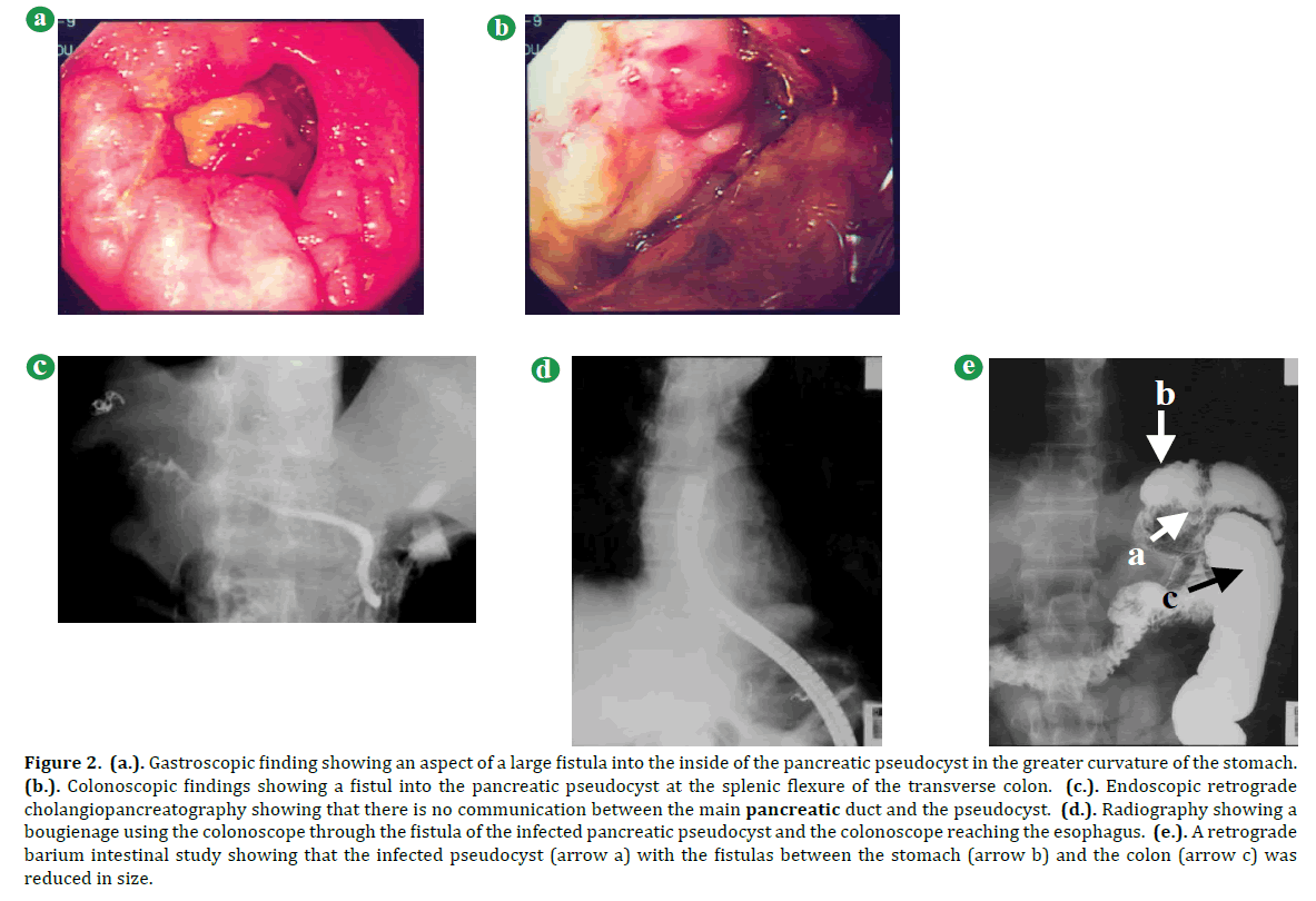 pancreas-gastroscopic-finding-aspect-fistula
