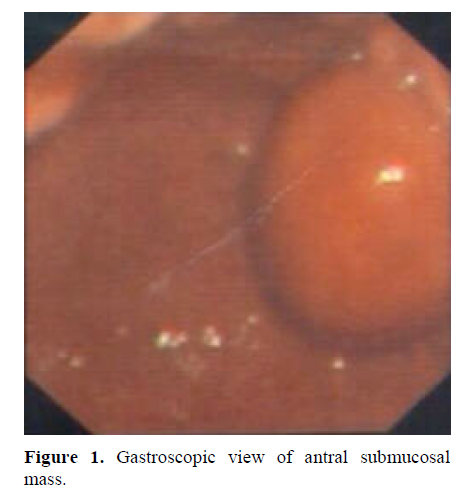 pancreas-gastroscopic-view-antral