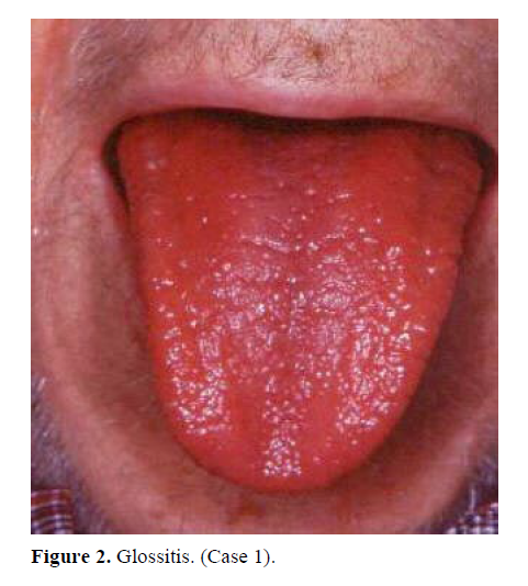 pancreas-glossitis-case