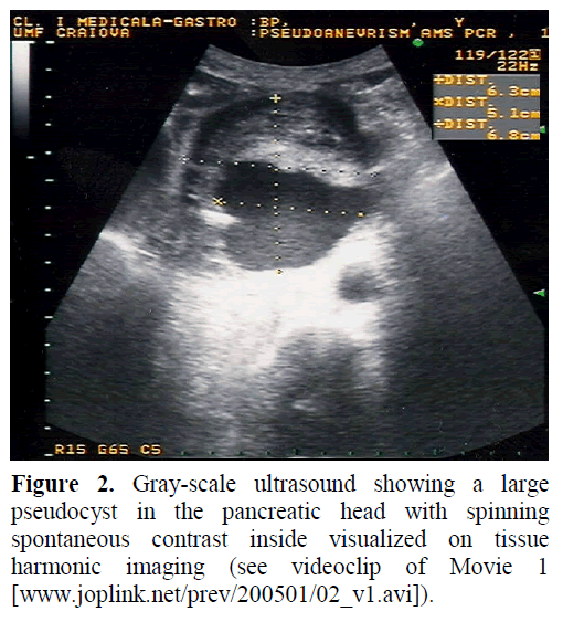 pancreas-gray-scale-ultrasound-pseudocyst