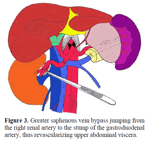 pancreas-greater-saphenous-vein-bypass