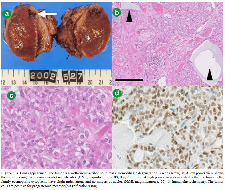 pancreas-gross-appearance-circumscribed