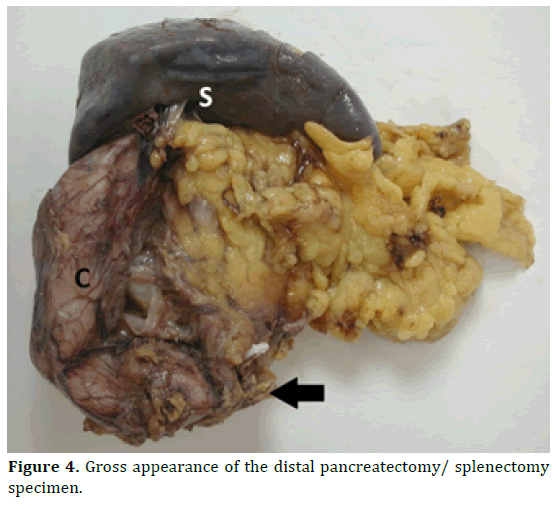 pancreas-gross-appearance-pancreatectomy