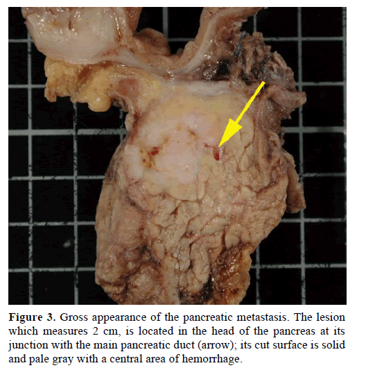 pancreas-gross-appearance-pancreatic