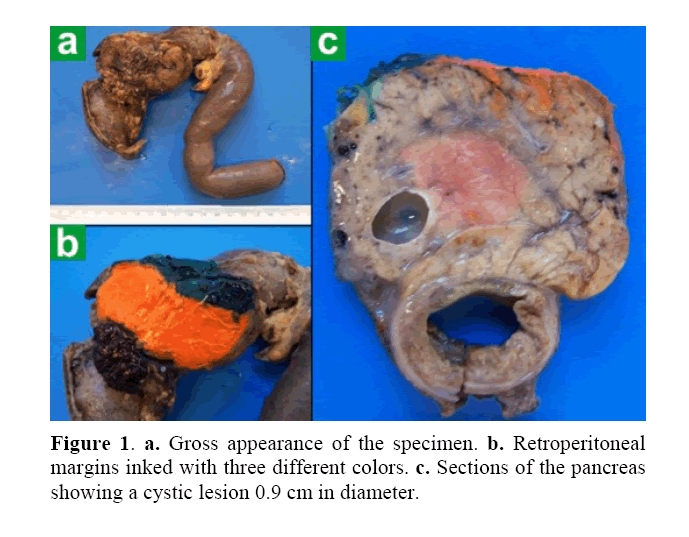 pancreas-gross-appearance-specimen