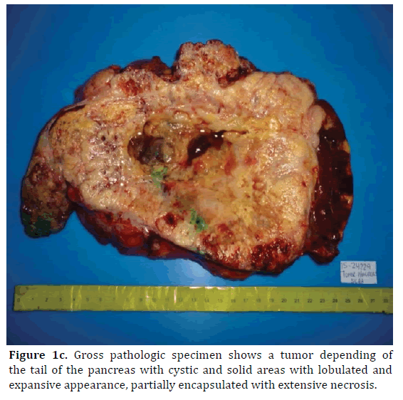pancreas-gross-pathologic-specimen