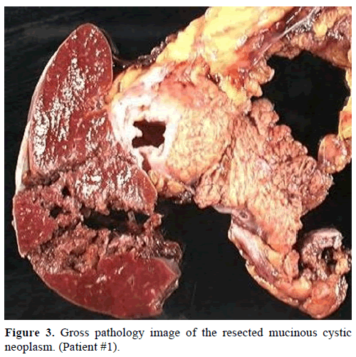 pancreas-gross-pathology-mucinous