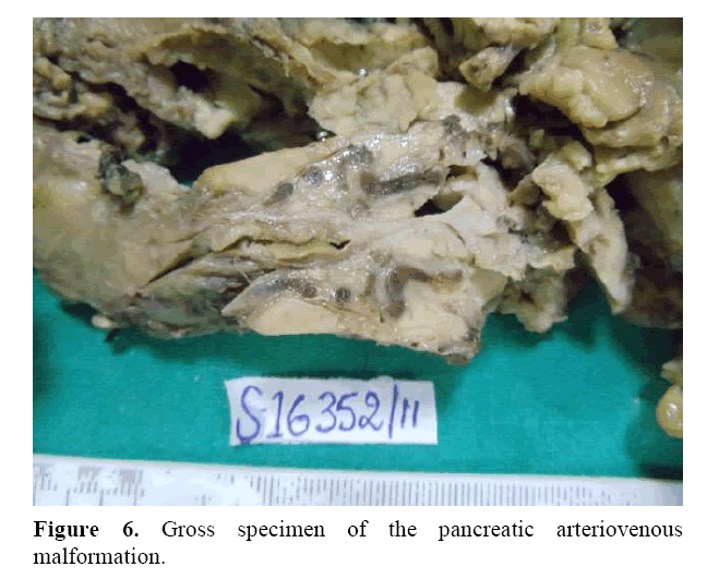 pancreas-gross-specimen-pancreatics