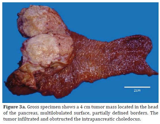 pancreas-gross-specimen-tumor