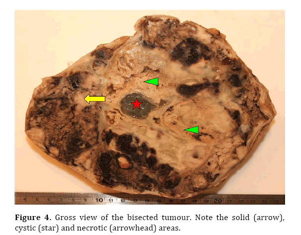 pancreas-gross-view-bisected-tumour