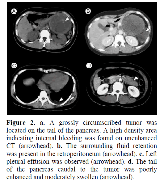 pancreas-grossly-circumscribed-tumor