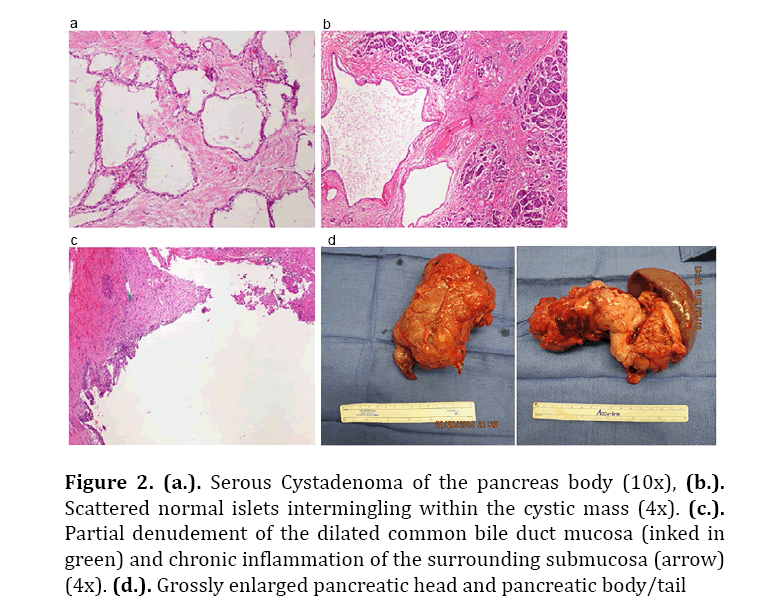 pancreas-grossly-enlarged-pancreatic