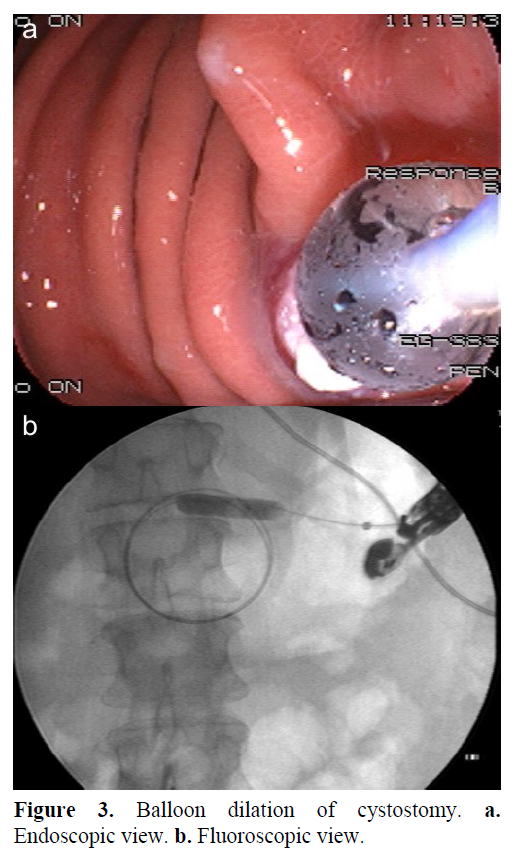 pancreas-guided-pseudocyst-drainage