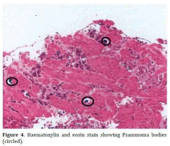 pancreas-haematoxylin-psammoma-bodies