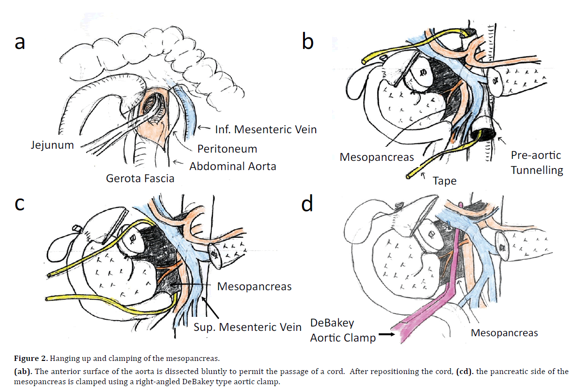 pancreas-hanging-clamping-mesopancreas