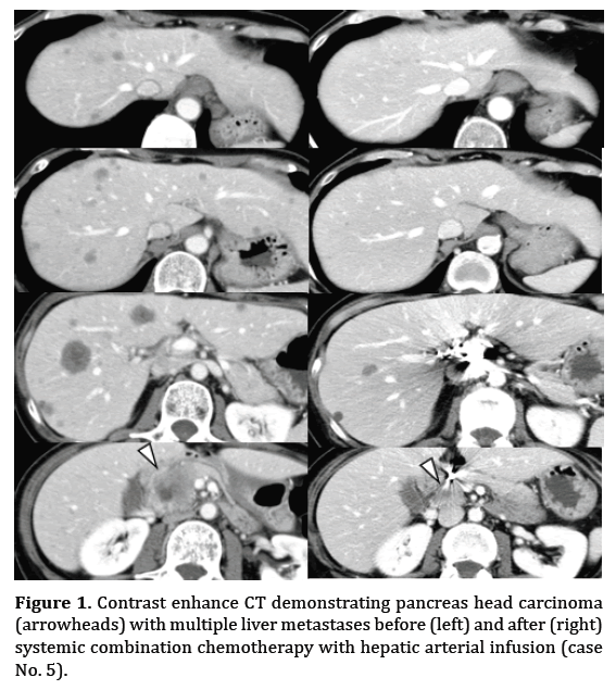 pancreas-head-carcinoma